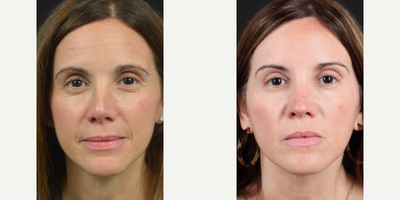 Woman treated with Rhinoplasty - I saw this lovely patient this week, 2 years after her complex tertiary revision rhinoplasty (surgery after 2 previous failed rhinoplasties somewhere else). It was a complex case in which all the normal nasal structures were essentially cut or removed. I used rib cartilage to make extended spreader grafts, a septal extension graft, alar replacement grafts and a tip graft. I was able to significantly lengthen her nose and un-pinch her tip; giving her a more natural appearance. She last picture shows the before, the projected result prior to surgery (using imaging software) and the actual result. She was so thrilled with her surgery she refers many friends and family to the practice. I am honored she chose me as her surgeon and I am happy I was able to help her after living so many years with a nose she hated.