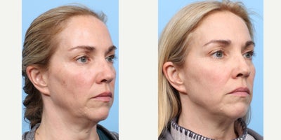 45-54 year old woman treated with PicoWay, Vbeam - To reduce the signs of aging and sun damage, this patient was treated three times with a combination of PicoWay, Vbeam, and Lutronic Ultra Laser. Her results are shown 1 month after her third session.