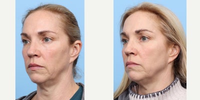 45-54 year old woman treated with PicoWay, Vbeam - To reduce the signs of aging and sun damage, this patient was treated three times with a combination of PicoWay, Vbeam, and Lutronic Ultra Laser. Her results are shown 1 month after her third session.