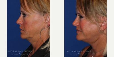55-64 year old woman treated with Facelift, Cheek Lift - Patient concerned with jowls and loose skin.