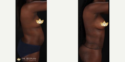 Woman treated with Breast Augmentation - Before and after breast augmentation and tummy tuck with vaser liposuction