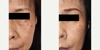 Asian Skin Brown Spot Removal with Q-Switched Lasers - Patient is a 50 something year old Asian female who was told her skin was not a candidate for laser age spot removal. Wrong! See what one q-switched Palomar Q-Yag V laser can do. Just because your dermatologist or cosmetic provider tells you they can't do something, it doesn't mean that it can't be done.