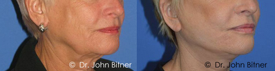 Lip Augmentation -
Lip Augmentation