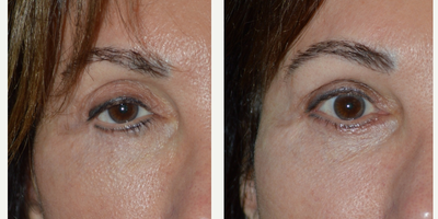 Middle age woman, underwent revision cosmetic eyelid surgery, canthoplasty, ptosis sx, fat injection - Middle age woman, with history of multiple prior eyelid operations with unnatural eye appearance, underwent revision cosmetic eyelid surgery, lower eyelid contouring and retraction surgery, canthoplasty, upper lid ptosis (droopy eyelid) surgery, and fat injection to upper eyelids/brows, resulting in more natural, youthful eye appearance.
