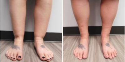 Woman treated with Liposuction - Yes, we can liposuction almost everything. even ankles. This young lady thought her ankles were full. Often the fullness is just due to bony anatomy or muscle which cannot be addressed with liposuction but this lady truly had lipodystrophy an abnormal accumulation of fat