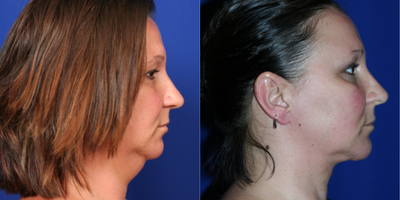 35-44 year old woman treated with Neck Lift - Female presenting with Liposculpture. Approximately 280cc of aspirate were obtained.