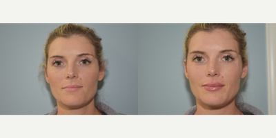 25-34 year old woman treated with Injectable Fillers - 34 year old female treated with 1 syringe of Juvederm Ultra to lips. After photos are immediately following treatment.