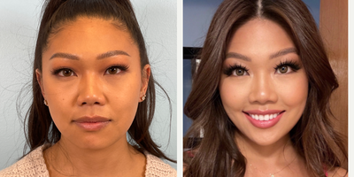 25-34 year old woman treated with Buccal Fat Removal, Radiesse - 25-34 year old woman treated with Buccal Fat Removal, Radiesse