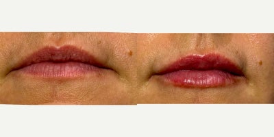 45-54 year old woman treated with Dermal Fillers - Non-Surgical Lip Augmentation with 1 syringe of Volbella