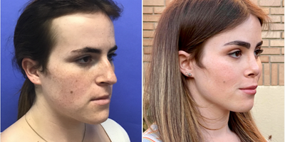Patient treated with Facial Feminization Surgery, Transgender Facial Feminization Surgery, Rhinoplasty, Septoplasty, Cheek Augme - 25 to 34 year-old female patient is 1 year post-op from Facial Feminization surgery. Her procedures included: Forehead Lift, Hairline Lowering, Orbital Bony Contouring, Septorhinoplasty (open) with Cartilage Grafts and Weirs, Cheek Implants (small combined), 2 cc Voluma to Medial Cheeks, Chin Reduction and Contour, Thyroid Cartilage Shave, Intranasal Lip Lift with Fat Augmentation, Soft Tissue to Nasolabial Folds, and 300 Micrografts to the Fronto Temporal Recessions.