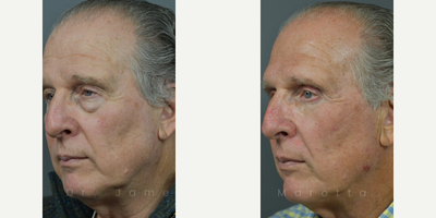 Man treated with Facial Fat Transfer - Before and After Upper/Lower Blepharoplasty with Fat Injections