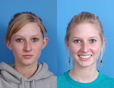 Otoplasty -
23 year old female wanted to have ears that were less prominent. Cosmetic Otoplasty was performed