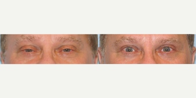 45-54 year old man treated with Ptosis Surgery - As we age, the eyelids can begin to droop resulting in sleepy eyes. In-office ptosis repair re-suspends the eyelids to restore the natural vibrance of the eyes. Post-op one month result is shown.