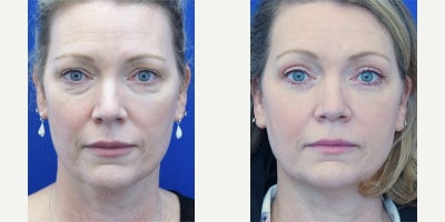 45-54 year old woman treated with Eyelid Surgery - The goal of cosmetic eyelid surgery is to make the eyes appear more attractive without the hint of having anything done. The scars are hidden and invisible to the naked eye. Post 3 months results shown.
