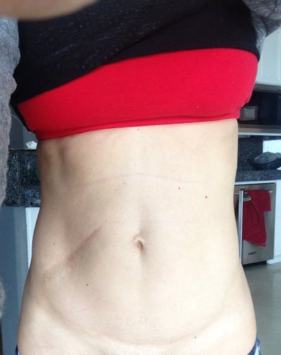 mini tummy tuck candidate