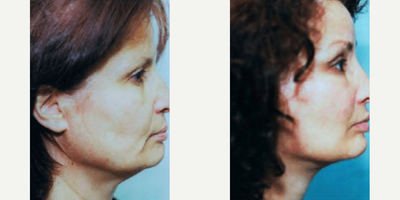 Woman treated with Facelift - Woman treated with Facelift