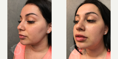 25-34 year old woman treated with Lip Augmentation - lip augmentation