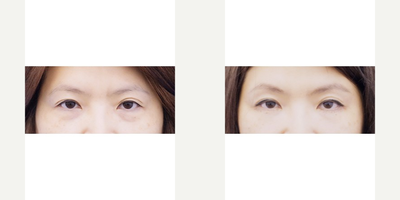 45-54 year old woman treated with Fat Transfer - Lower eyelid loose skin and hollow create a tired look in contrast to her upbeat personality. Conservative skin resection and fat grafting around the eyes achieve a natural youthful appearance.