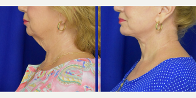 2209 75 and up year old woman treated with Facelift, Chin Implant - 2209 75 and up year old woman treated with Facelift, Chin Implant