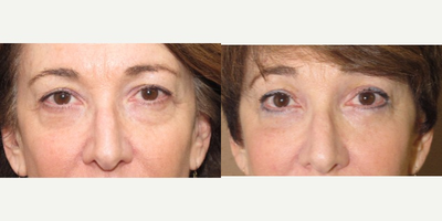 55-64 year old woman treated with Eyelid Surgery - 60 year old blepharoplasty