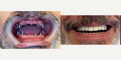55-64 year old man treated with Dental Bridge - Fixed bridges of porcelain crowns fitted on top of 6 implants on each jaw.