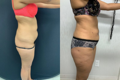 Woman treated with Liposuction - Woman treated with Liposuction.
