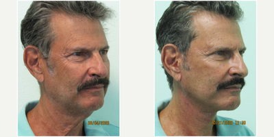 60+ year old man treated with Neck Lift and Lower Facelift Under Local Anesthesia - This male presented with what he described as a genetic heavy neck that he had since his 30s. He was content with the majority of facial aging, but did wish to improve his profile, jowls, and the turkey neck that presented over the past decade.We decided in consultation to perform a necklift and lower facelift under local anesthesia in our office (utilizing only mild oral sedation with valium).Incisions were made in front and behind the ears along with one small one under his chin. Most sutures were removed at one week. Procedure time for his procedure was slightly over two hours time.His results demonstrate marked improvement of his profile and jawline while maintaining a natural and masculine appearance.