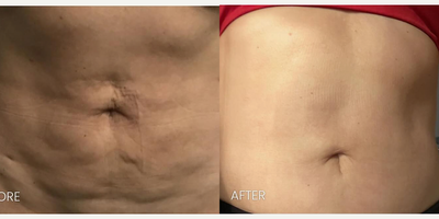 45-54 year old woman treated with Secret Pro Radiofrequency Microneedling and CO2 - Before and After: Secret Pro Radiofrequency Microneedling and CO2Our 50-year-old female patient wanted to tighten her skin after Liposuction to match her amazing figure! After 2 sessions of radiofrequency microneedling to stimulate collagen production and help the skin to contract, as well as 2 sessions of CO2 laser to resurface the skin she has achieved her goals! Time for a bikini this summer!