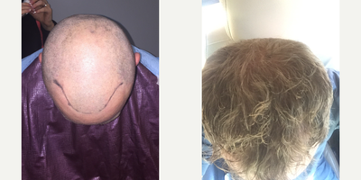 35-44 year old man treated with Hair Loss Treatment - Pt rebuilt hairline and added density in front with 1854 grafts via Robotic assisted FUE. Also began a medical therapy program.