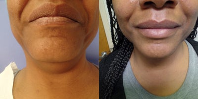 55-64 year old woman treated with FaceTite - FaceTite of chin, Jowls and neck