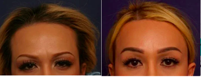 Forehead Reduction - FFS- Hairline Forehead Lift (Brow Lift) - Hairline Lowering (Forehead Reduction) - Orbital Bony Contour (Brow Bone Reduction)
