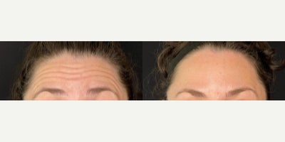 Forehead Anti Wrinkle Treatment - Forehead lines treated with neuromodulator (Botox/Dysport)