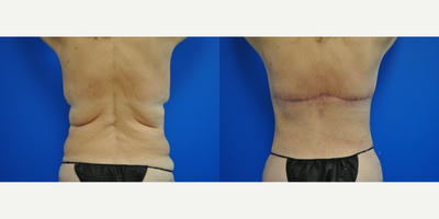 55-64 year old woman treated with Tummy Tuck, Liposuction, Body Lift, Breast Lift - This patient had a skin-only tummy tuck with liposuction of the flanks and inner thighs; bilateral breast lift and a bra-line back lift. She looks amazing!