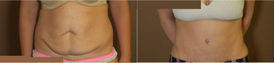 Woman treated with Tummy Tuck - Woman treated with Tummy Tuck