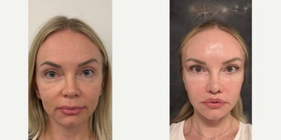 45-54 year old woman treated with Deep Plane Facelift, Eyelid Surgery, Cheek Lift - deep plane face lift and lower blepharoplasty + cheeklift was performed - 1 month post-op before after
