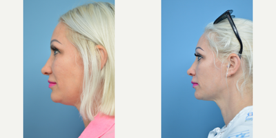 35-44 year old woman treated with Kybella - 37 year old female concerned with fullness in the neck area. She was treated with 2 Kybella treatments address her concerns.