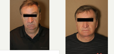 45-54 year old man treated with Facelift - blepharoplasty and facelift