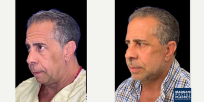 55-64 year old man treated with Facelift - Deep Planeface lift under oral sedation