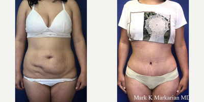 18-24 year old woman treated with Tumescent Liposuction - A woman in her 20's is shown 2 months postop from a TummyTuck with Liposuction.