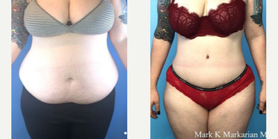 25-34 year old woman treated with Tumescent Liposuction - A woman in her 30's is shown 3 months postop from a Tummy Tuck with Liposuction.