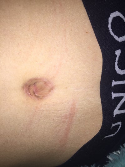 Tummy tuck and belly button scar got darker - any help ...