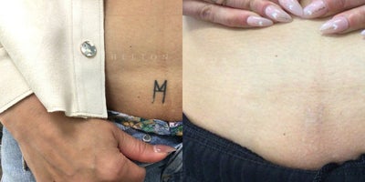 25-34 year old woman treated with Tattoo Removal, Laser Peel - 32 year old woman treated with 5 Picoplus Treatments for tattoo removal