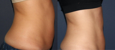 25-34 year old woman treated with UltraShape - Before and after UltraShape treatment for abdomen.