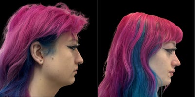 35-44 year old transgender woman treated with Facial Feminization Surgery - The transformational results of facial feminization surgery.