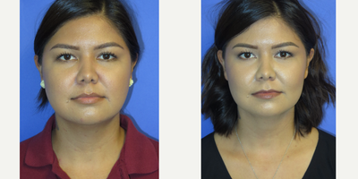27 year old woman treated with Chin Liposuction and Buccal Fat Pad Reduction - This is a 27 year old female who desired a slimmer neckline and lower face. She had chin lipo and buccal fat pad reduction. Note the definition achieved in the neck, jawline, and lower face.