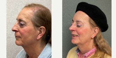 65-74 year old woman treated with Adam's Apple Reduction, Brow Bone Reduction, Brow Lift, Septoplasty, Rhinoplasty, Lip Lift, Ch - This lady underwent facial feminization surgery including forehead feminization, nasal feminization, cheek augmentation, chin feminization and adams apple reduction.