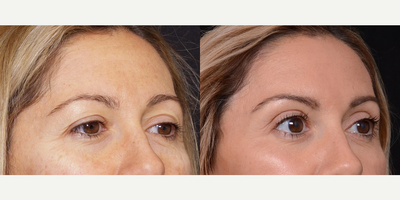 Woman treated with Restylane Contour - Woman treated with Restylane Contour