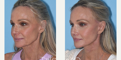 65-74 year old woman treated with Facelift, Facial Fat Transfer - DeepPlane Facelift, Platysmaplasty, Lip lift, Lipografting & CO2 laser resurfacing of the face.