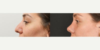 25-34 year old woman treated with Rhinoplasty - Open rhinoplasty
