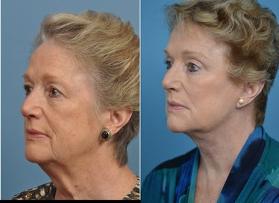 75 and up year old woman treated with Mini Lift - 78 year old female concerned with aging in the lower face and neck. She was successfully treated with a mini lift.
